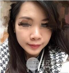 鼻梁宽1