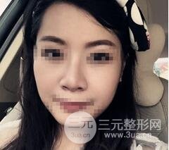 鼻梁宽8