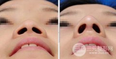 鼻头缩小手术需要多少钱？影响价格的因素有哪些？