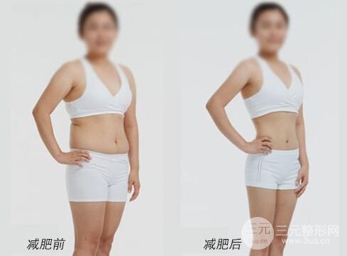 360度吸脂减肥有什么优点、吸脂减肥价格多少