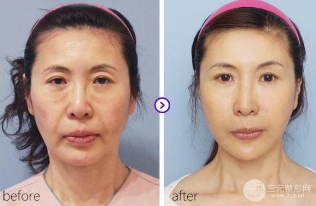 玻尿酸针一针多少钱全新抗衰除皱费用表一览