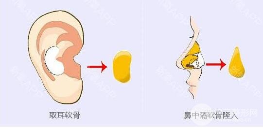 自体耳软骨隆鼻手术的价格 耳软骨隆鼻的果怎么样