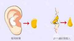 自体耳软骨隆鼻好吗 自体耳软骨隆鼻好吗
