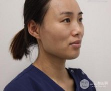 隆鼻手术疼不疼?重庆军美真实隆鼻案例过程分享 隆鼻手术疼不疼?重庆军美真实隆鼻案例过程分享