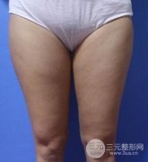 吸脂减肥降低风险吗 吸脂减肥前后对比及术后恢复分享