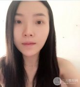 武汉叶子玻尿酸垫下巴真实案例和面部项目价格分享