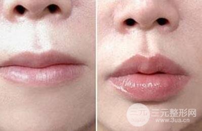丰唇手术价格 自体脂肪丰唇整形全过程对比图