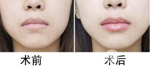 丰唇手术价格 自体脂肪丰唇整形全过程对比图