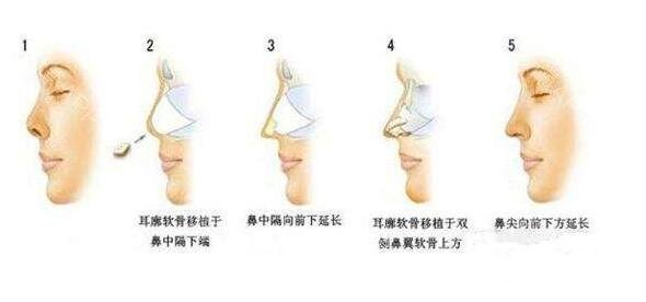 自体耳软骨隆鼻价格 自体软骨隆鼻整形手术果如何
