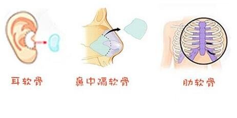 自体耳软骨隆鼻价格 自体软骨隆鼻整形手术果如何