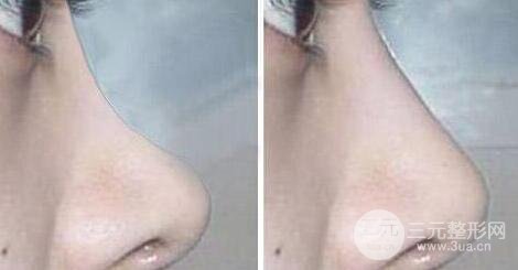自体耳软骨隆鼻价格 自体软骨隆鼻整形手术果如何