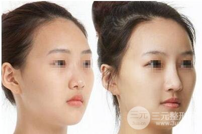 自体耳软骨隆鼻价格 自体软骨隆鼻整形手术果如何