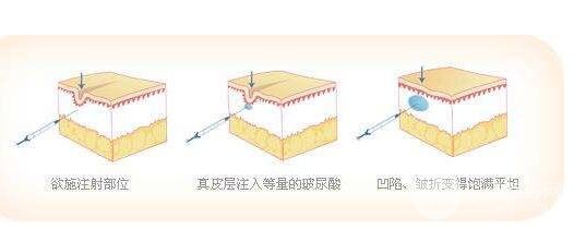 国产玻尿酸价格是多少 进口玻尿酸有哪些品牌呢
