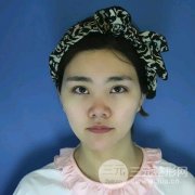 鼻头肥大缩小术恢复过程图 隆鼻整形前后对比