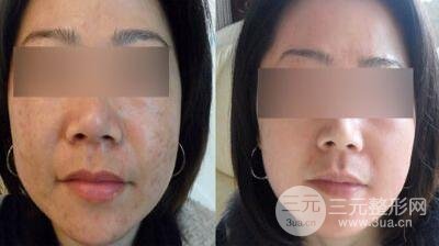 激光全身美白多少钱 激光美白的术后果怎么样呢