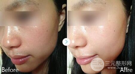激光全身美白多少钱 激光美白的术后果怎么样呢