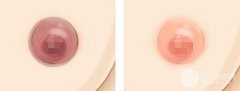 乳晕黑怎么办、乳晕漂红术多少钱
