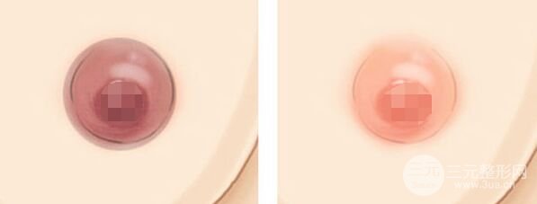 乳晕黑怎么办、乳晕漂红术多少钱