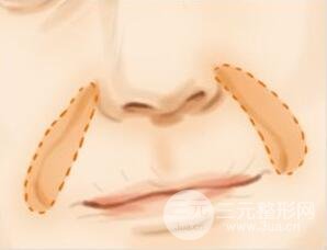 注射丰鼻唇沟多少钱 自体脂肪丰鼻唇沟果怎么样