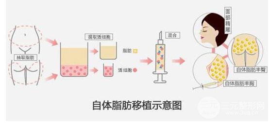 注射丰鼻唇沟多少钱 自体脂肪丰鼻唇沟果怎么样