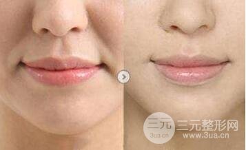 注射丰鼻唇沟多少钱 自体脂肪丰鼻唇沟果怎么样