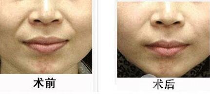 注射丰鼻唇沟多少钱 自体脂肪丰鼻唇沟果怎么样