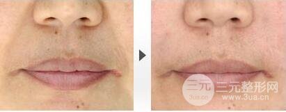 注射丰鼻唇沟多少钱 自体脂肪丰鼻唇沟果怎么样