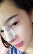 鼻部矫正塑形|硅胶隆鼻一个月真实恢复果分享 鼻部矫正塑形|硅胶隆鼻一个月真实恢复果分享