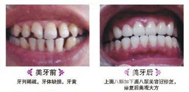 烤瓷牙价格和种类有哪些|烤瓷牙果对比图