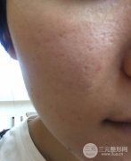 果酸换肤的果怎么样？果酸换肤真实经验来分享~