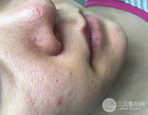 果酸换肤的果6