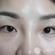 三点式双眼皮真实案例分享，并附上前后对比图~
