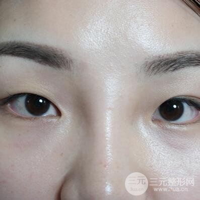 三点式双眼皮1
