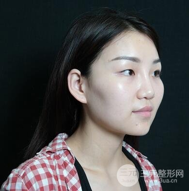 三点式双眼皮2