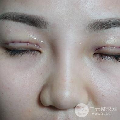三点式双眼皮3