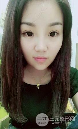 三点式双眼皮7