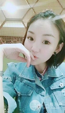 三点式双眼皮10