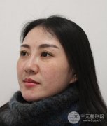 去眼袋降低风险吗？去眼袋手术真实案例分享~并有前后对比图