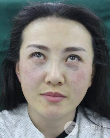 去眼袋降低风险吗3