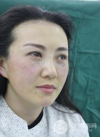 去眼袋降低风险吗4