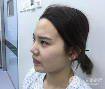 鼻头肥大缩小术2