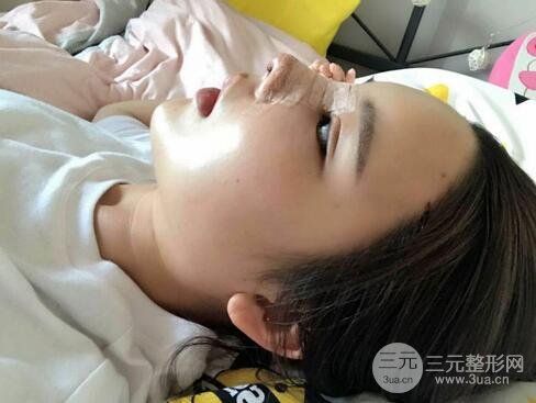 鼻头肥大缩小术3