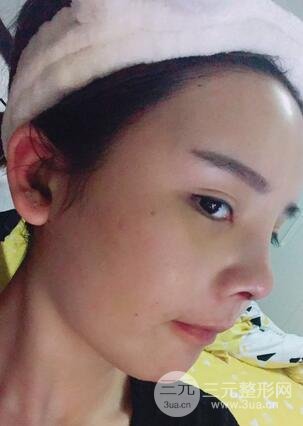 鼻头肥大缩小术5