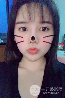 鼻头肥大缩小术7