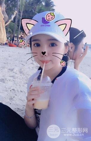 鼻头肥大缩小术8
