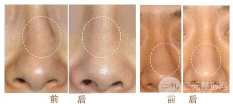 假体隆鼻失败可以取出吗，取出隆鼻假体多少钱？