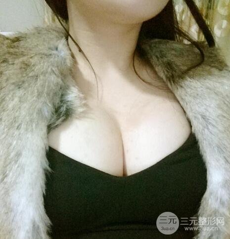 自体脂肪隆胸10
