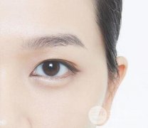 益阳开眼角手术费用要多少钱