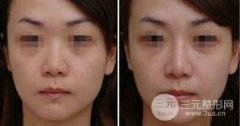 伊f露隆鼻和玻尿酸隆鼻有区别吗，伊f露注射隆鼻好吗