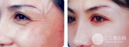 眼睛下面有小细纹怎么办，去眼纹方法有哪些